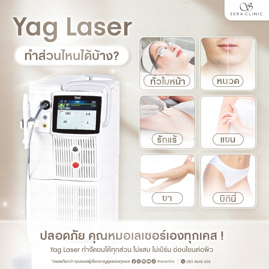 Yag Laser กำจัดขน