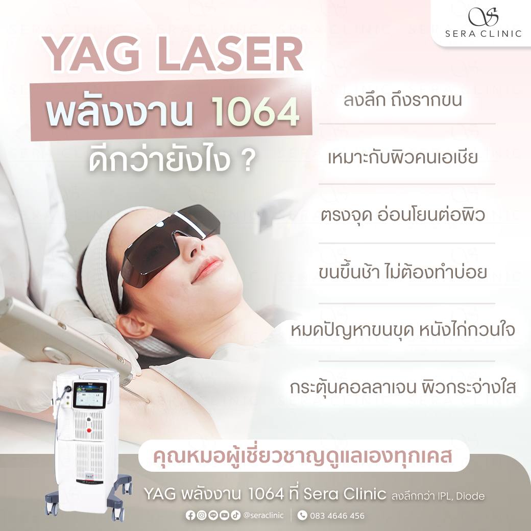 Yag Laser กำจัดขน