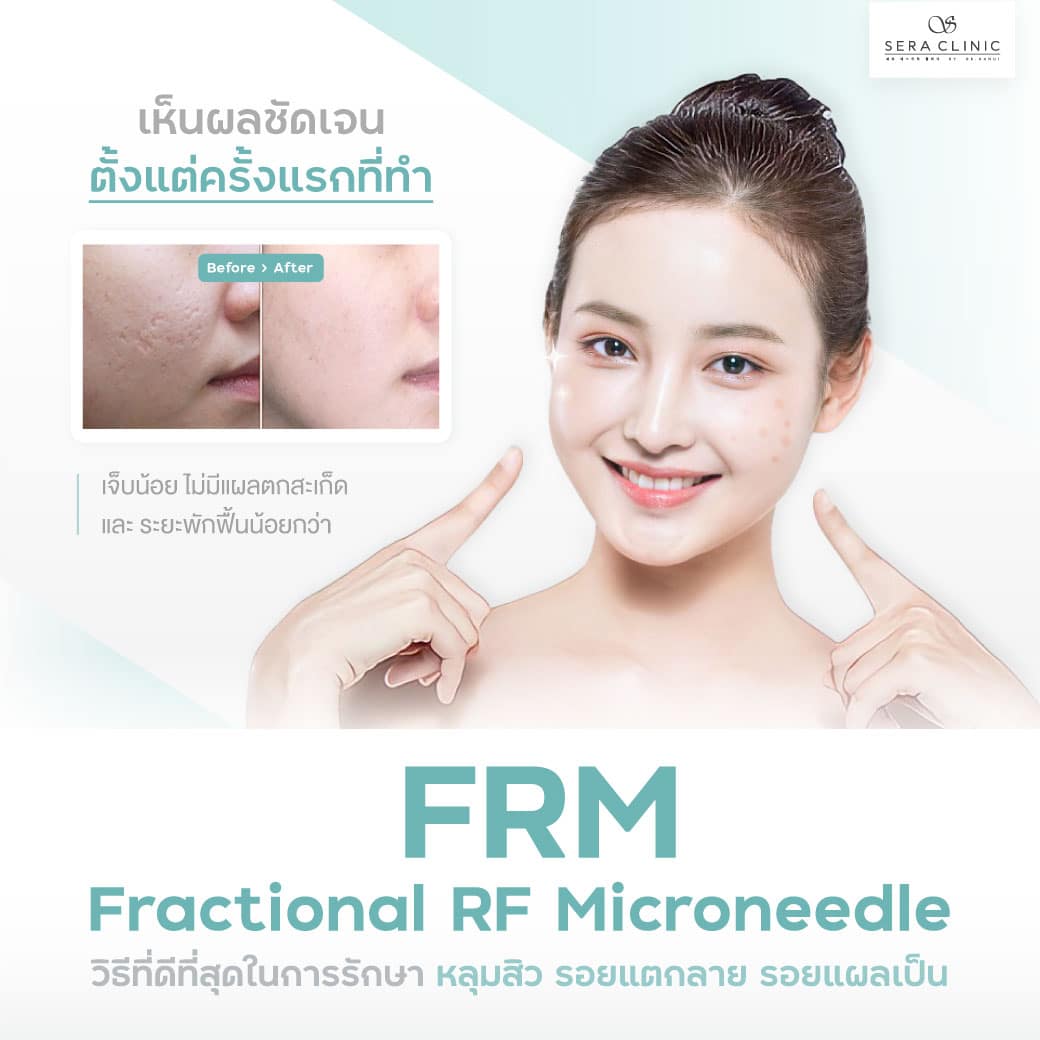 Fractional RF Microneedle FRM หลุมสิว รอยแตกลาย รอยแผลเป็น