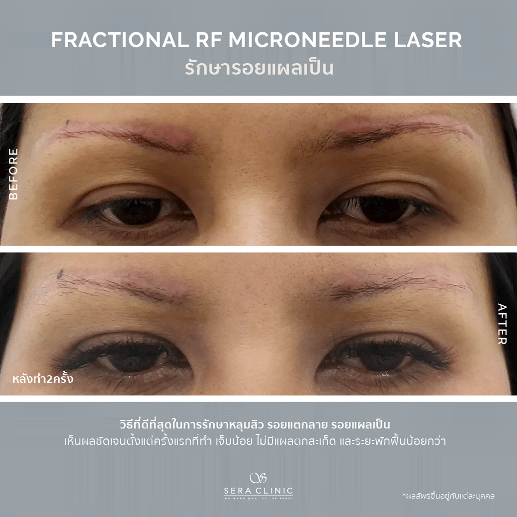 Sera Clinic before and after RF Micro Needle