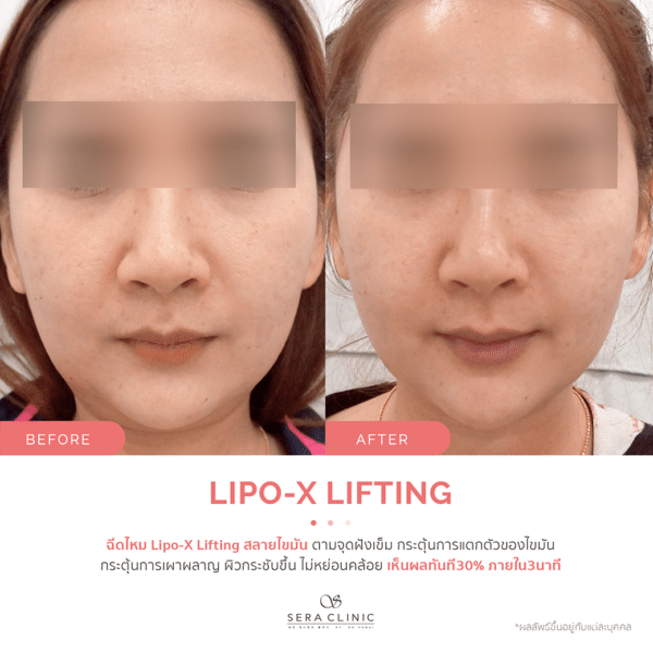 Sera Clinic เซรา คลินิก before and after Lipo-X Lipo-TOX Lifting ฉีดแฟต สลายไขมัน เมโสแฟต meso fat ยกกระชับ ลดไขมันSera Clinic before and after Lipo-X Lipo-TOX Lifting ฉีดแฟต สลายไขมัน เมโสแฟต meso fat ยกกระชับ ลดไขมัน