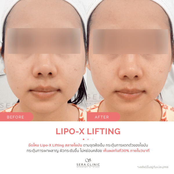 Sera Clinic เซรา คลินิก before and after Lipo-X Lipo-TOX Lifting ฉีดแฟต สลายไขมัน เมโสแฟต meso fat ยกกระชับ ลดไขมันSera Clinic before and after Lipo-X Lipo-TOX Lifting ฉีดแฟต สลายไขมัน เมโสแฟต meso fat ยกกระชับ ลดไขมัน