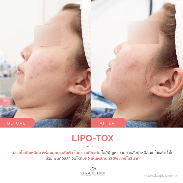 Sera Clinic เซรา คลินิก before and after Lipo-X Lipo-TOX Lifting ฉีดแฟต สลายไขมัน เมโสแฟต meso fat ยกกระชับ ลดไขมันSera Clinic before and after Lipo-X Lipo-TOX Lifting ฉีดแฟต สลายไขมัน เมโสแฟต meso fat ยกกระชับ ลดไขมัน