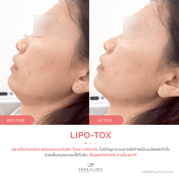 Sera Clinic เซรา คลินิก before and after Lipo-X Lipo-TOX Lifting ฉีดแฟต สลายไขมัน เมโสแฟต meso fat ยกกระชับ ลดไขมันSera Clinic before and after Lipo-X Lipo-TOX Lifting ฉีดแฟต สลายไขมัน เมโสแฟต meso fat ยกกระชับ ลดไขมัน