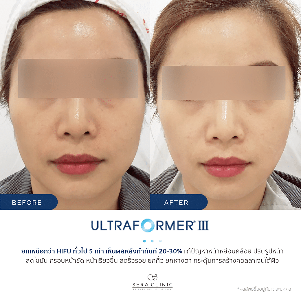 Sera Clinic Before and After - Hifu Ultra Former