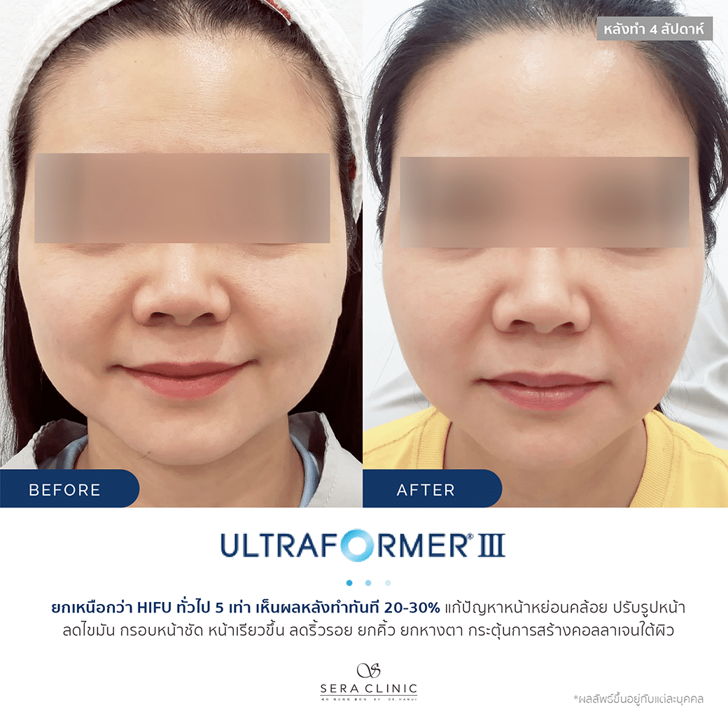 Sera Clinic Before and After - Hifu Ultra Former