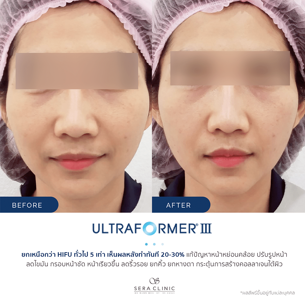 Sera Clinic Before and After - Hifu Ultra Former