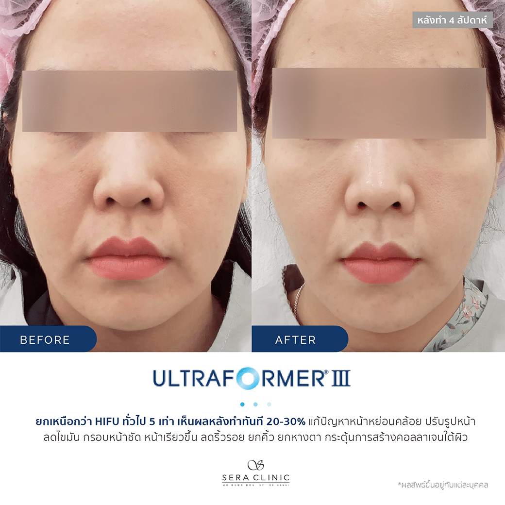 Sera Clinic Before and After - Hifu Ultra Former