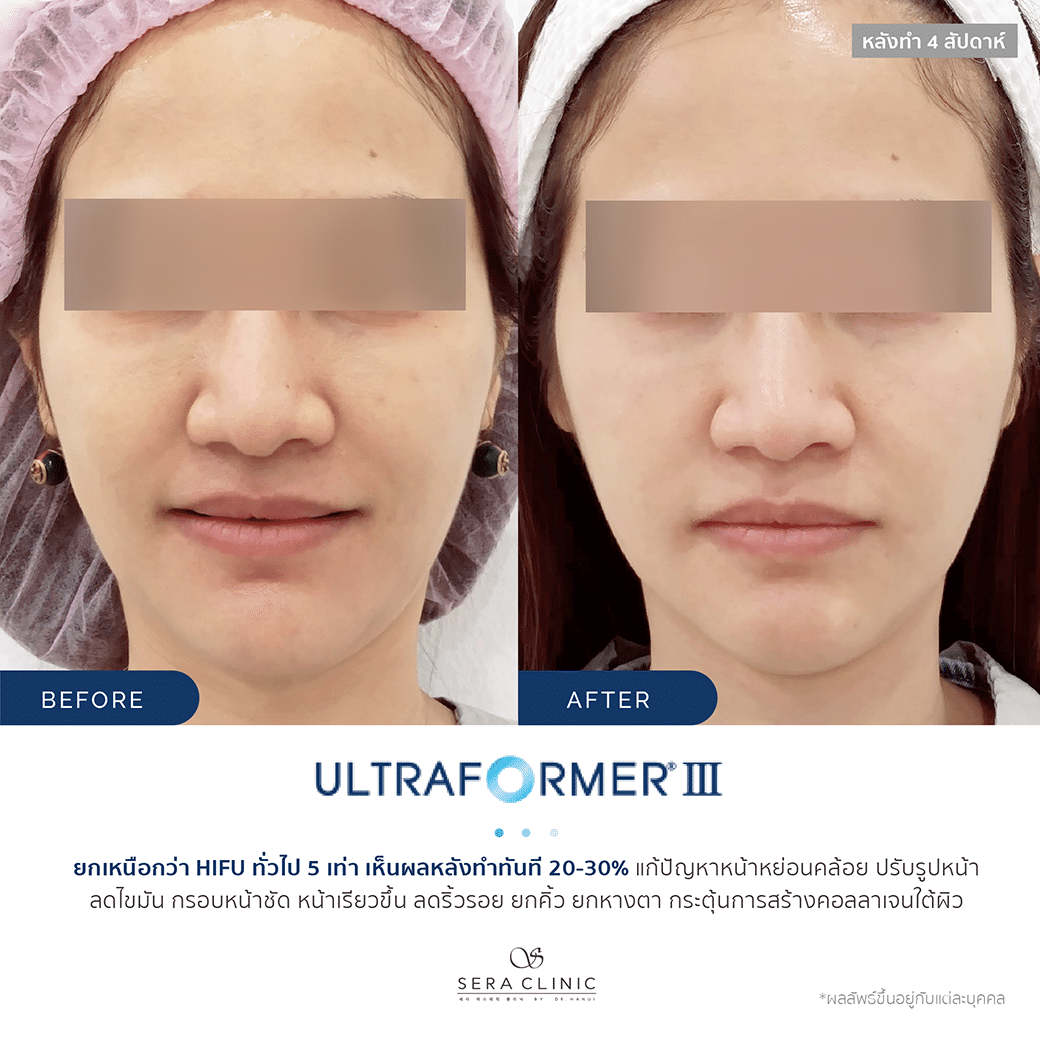 Sera Clinic Before and After - Hifu Ultra Former