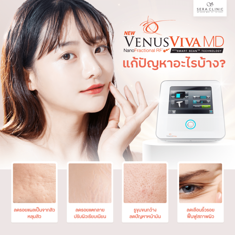 Sera Clinic Venus Viva MD Laser เลเซอร์รักษาหลุมสิว กระชับรูขุมขน ผิวแตกลาย ผิวเปลือกส้ม เพื่อผิวใส เรียบเนียน