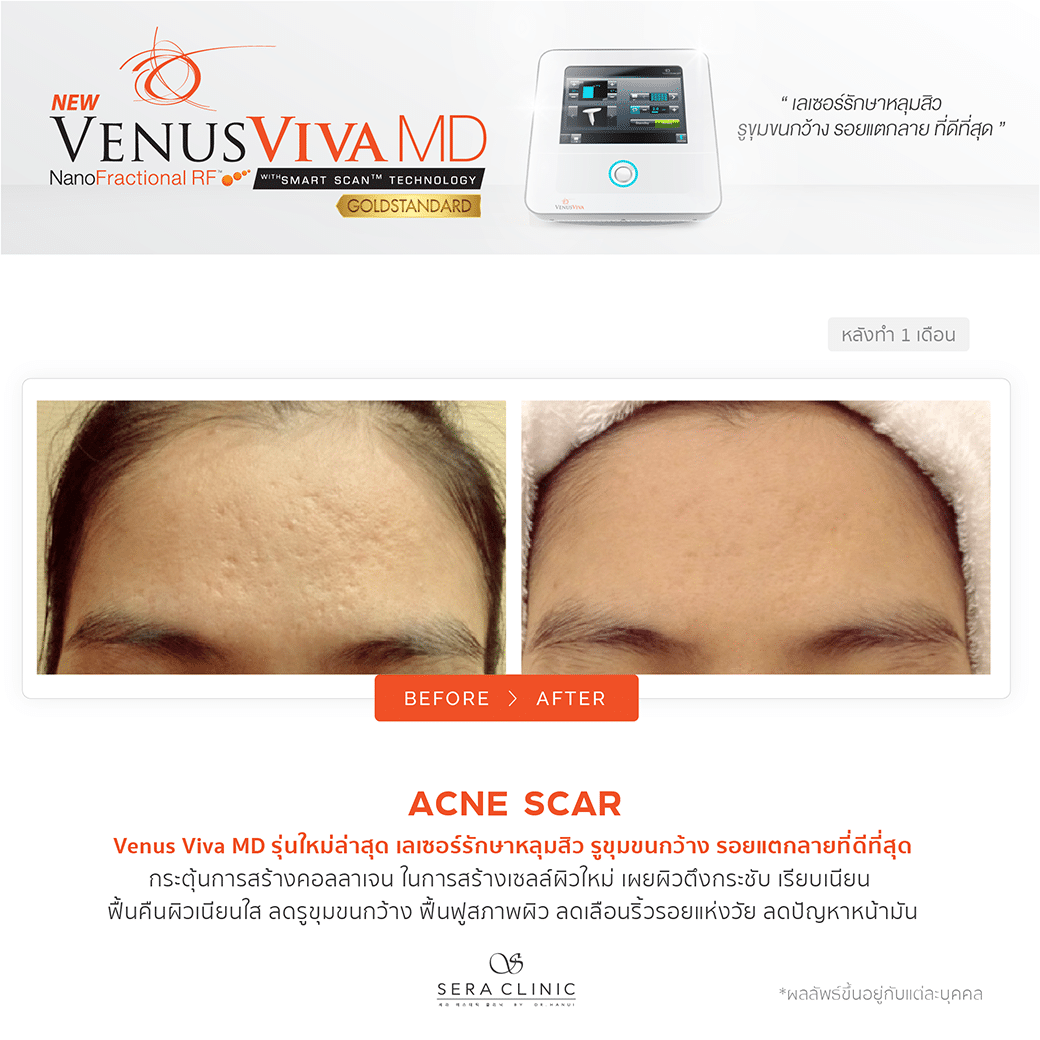 Sera Clinic before and after Venus Viva