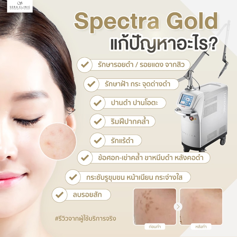 ผิวใส ไร้รอยดำ ด้วย Spectra Gold รักษาฝ้า กระ จุดด่างดำ - Sera Clinic