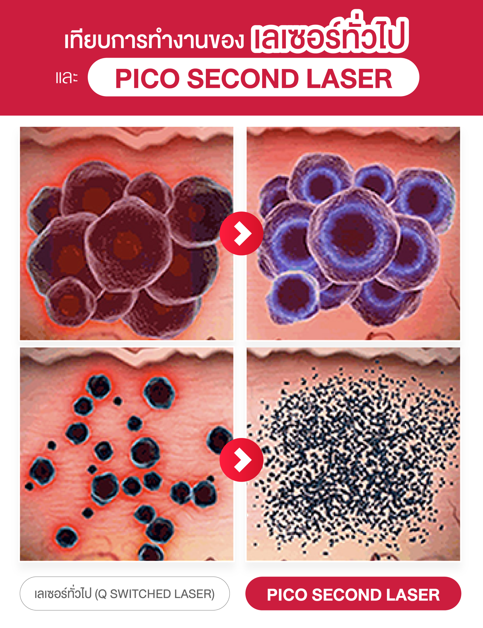การทำงานของ Pico Second Laser เลเซอร์รักษาฝ้า กระ จุดด่างดำ อันดับ 1 ที่ลูกค้าเลือกมากที่สุด