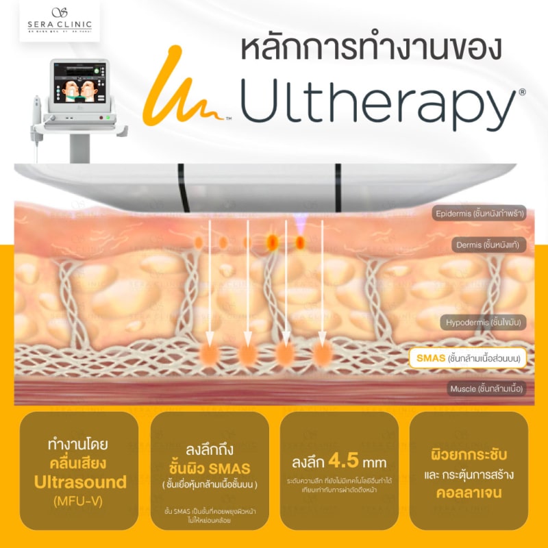 หลักการทำงานของ ultherapy ยกกระชับผิว ด้วยขั้นตอน SPT