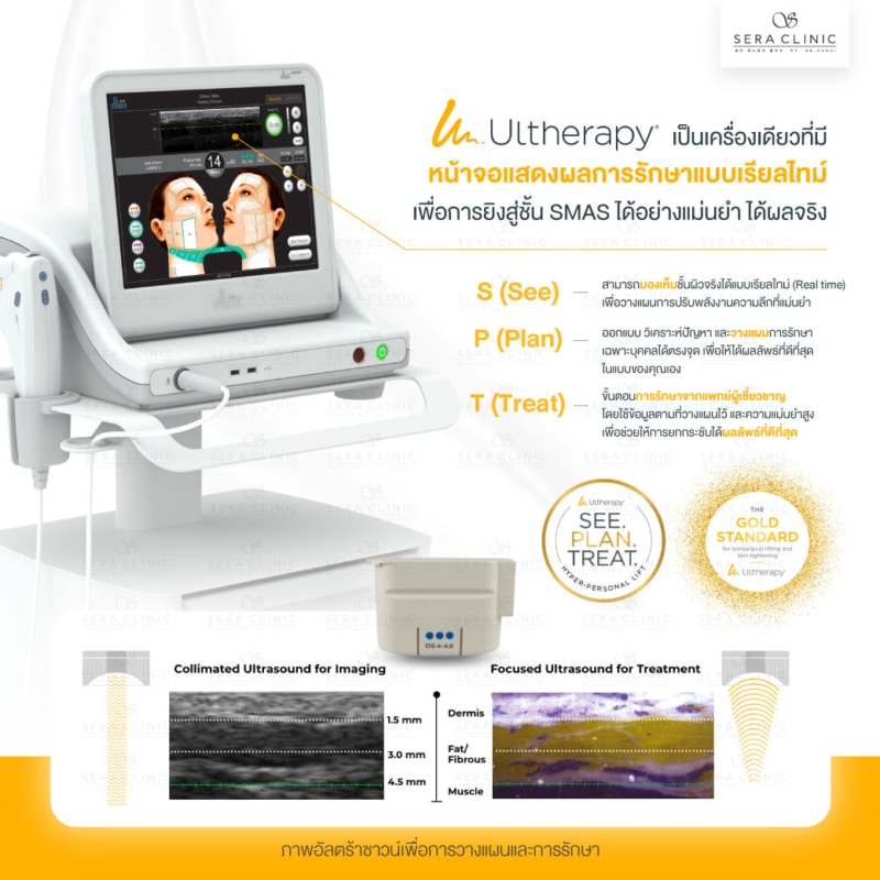 หลักการทำงานของ ultherapy ยกกระชับผิว ด้วยขั้นตอน SPT