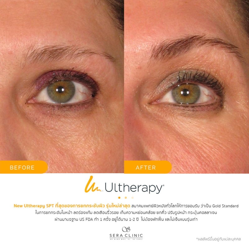 ultherapy SPT ยกกระชับผิว ลดริ้วรอย ปรับรูปหน้าเรียว ลดเหนียง