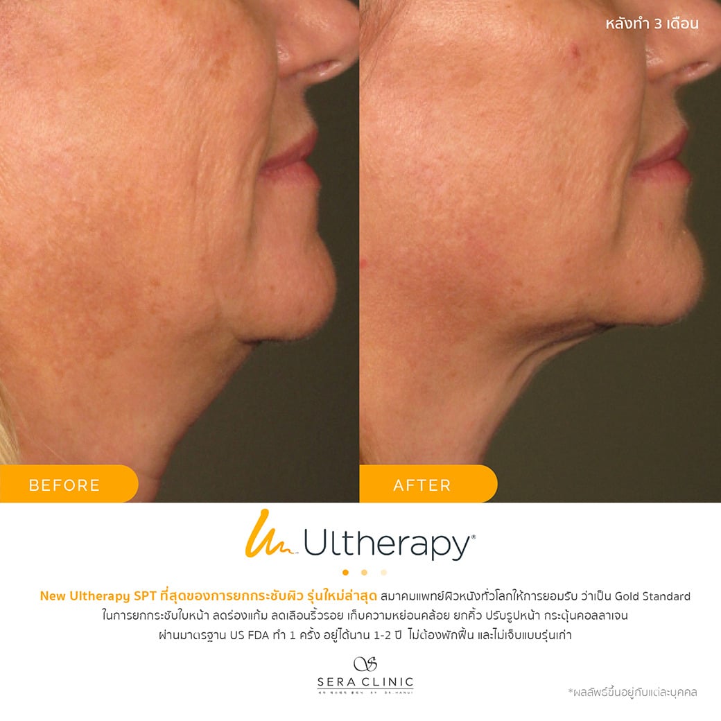 ultherapy SPT ยกกระชับผิว ลดริ้วรอย ปรับรูปหน้าเรียว ลดเหนียง