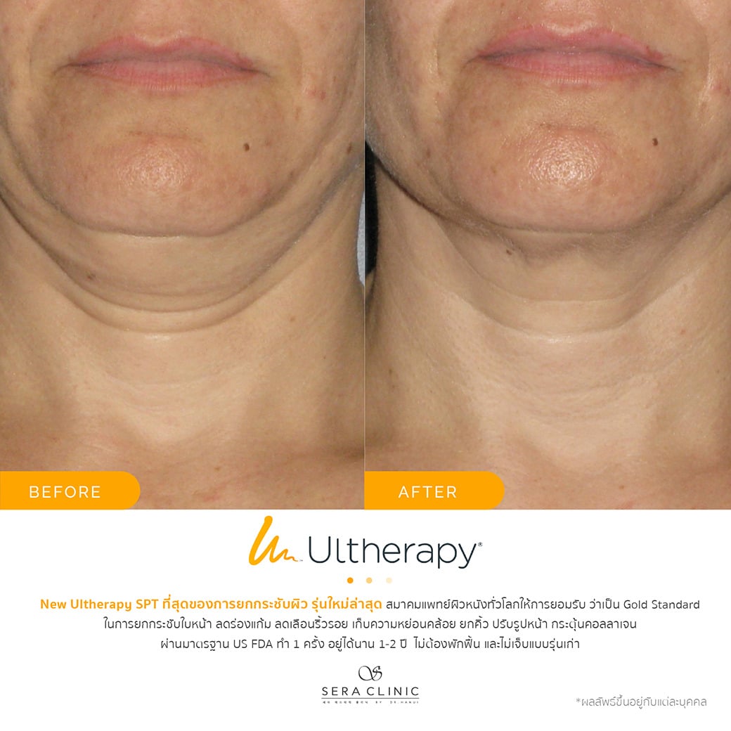 ultherapy SPT ยกกระชับผิว ลดริ้วรอย ปรับรูปหน้าเรียว ลดเหนียง