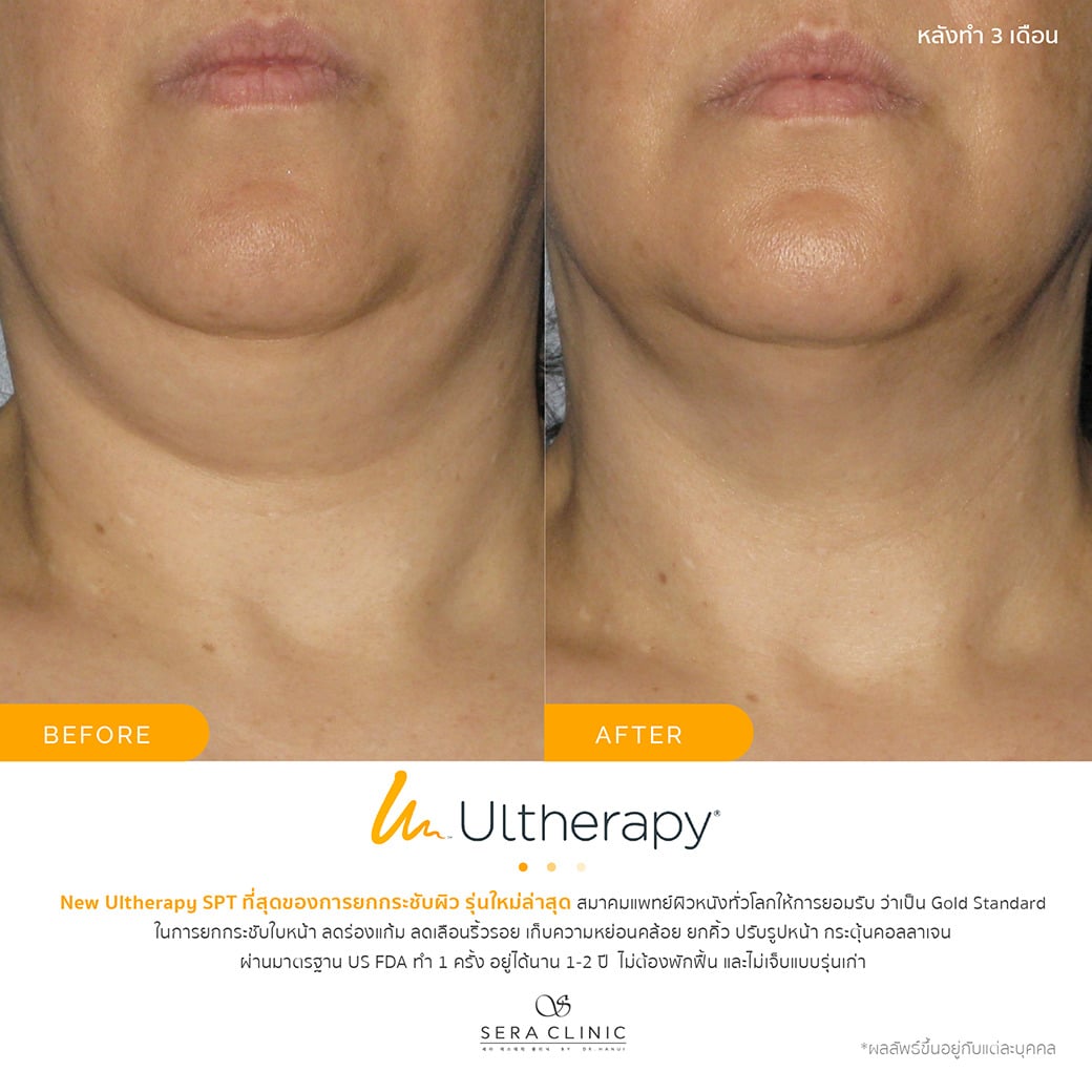 ultherapy SPT ยกกระชับผิว ลดริ้วรอย ปรับรูปหน้าเรียว ลดเหนียง