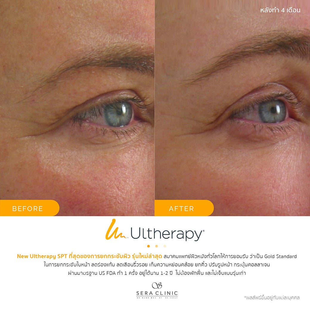 ultherapy SPT ยกกระชับผิว ลดริ้วรอย ปรับรูปหน้าเรียว ลดเหนียง