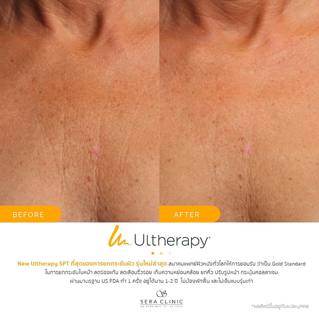 ultherapy SPT ยกกระชับผิว ลดริ้วรอย ปรับรูปหน้าเรียว ลดเหนียง