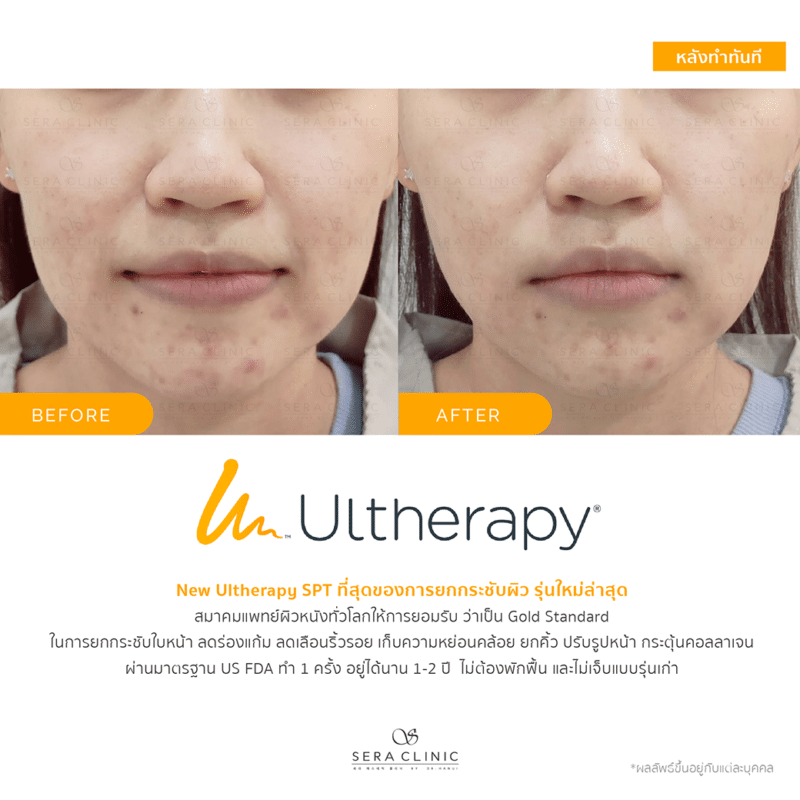 ultherapy SPT ยกกระชับผิว ลดริ้วรอย ปรับรูปหน้าเรียว ลดเหนียงultherapy SPT ยกกระชับผิว ลดริ้วรอย ปรับรูปหน้าเรียว ลดเหนียง