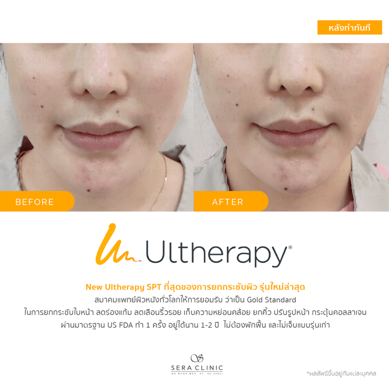 ultherapy SPT ยกกระชับผิว ลดริ้วรอย ปรับรูปหน้าเรียว ลดเหนียงultherapy SPT ยกกระชับผิว ลดริ้วรอย ปรับรูปหน้าเรียว ลดเหนียง