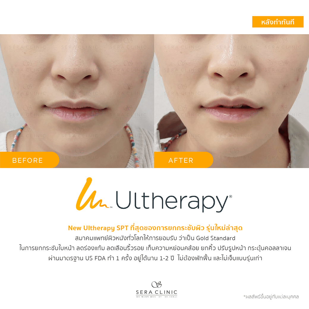 ultherapy SPT ยกกระชับผิว ลดริ้วรอย ปรับรูปหน้าเรียว ลดเหนียง