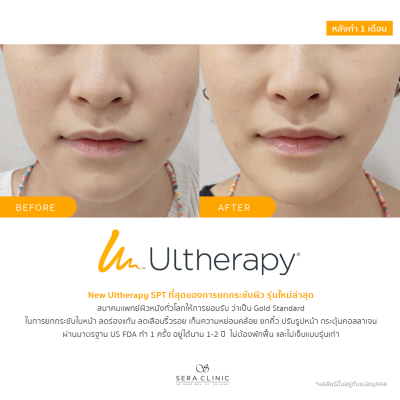 ultherapy SPT ยกกระชับผิว ลดริ้วรอย ปรับรูปหน้าเรียว ลดเหนียง