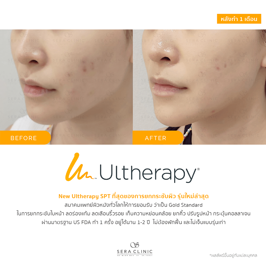 ultherapy SPT ยกกระชับผิว ลดริ้วรอย ปรับรูปหน้าเรียว ลดเหนียง