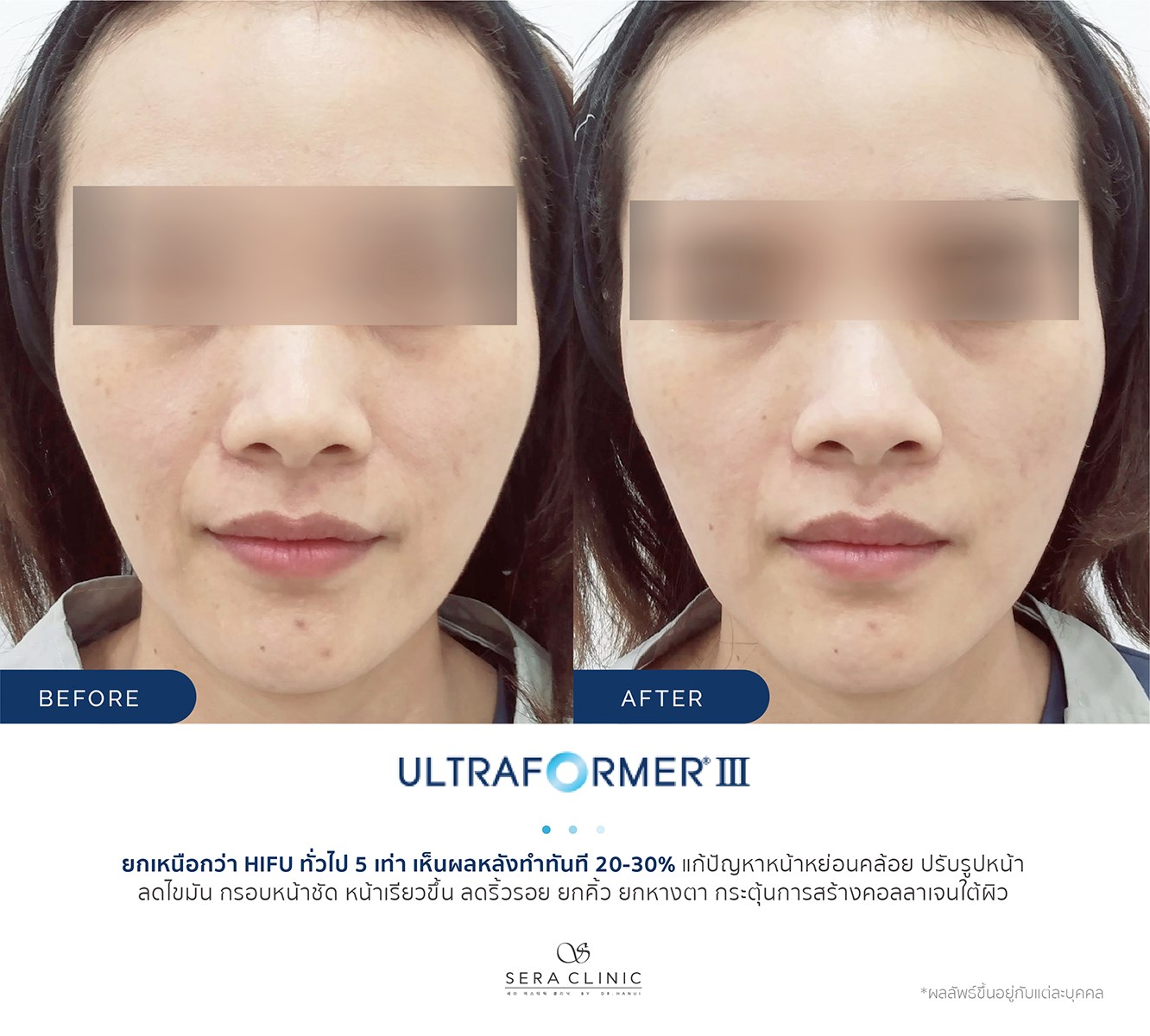review รีวิว Ultraformer lll ยกกระชับ หน้าเรียว ลดเหนียง