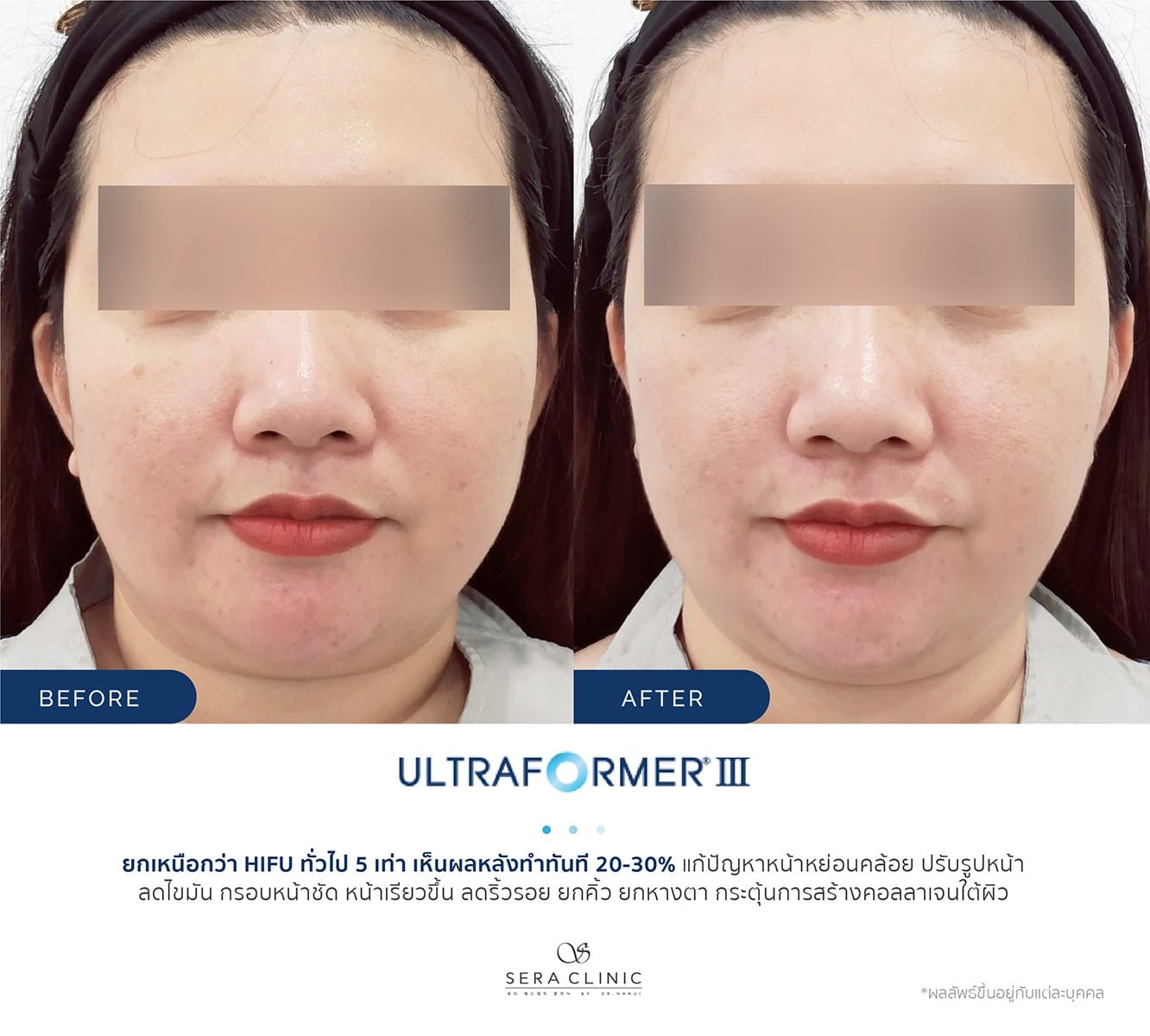 review รีวิว Ultraformer lll ยกกระชับ หน้าเรียว ลดเหนียง