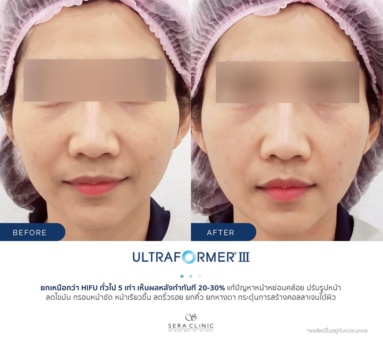 review รีวิว Ultraformer lll ยกกระชับ หน้าเรียว ลดเหนียง