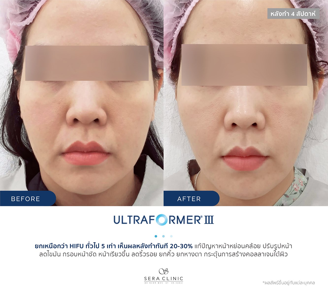 review รีวิว Ultraformer lll ยกกระชับ หน้าเรียว ลดเหนียง
