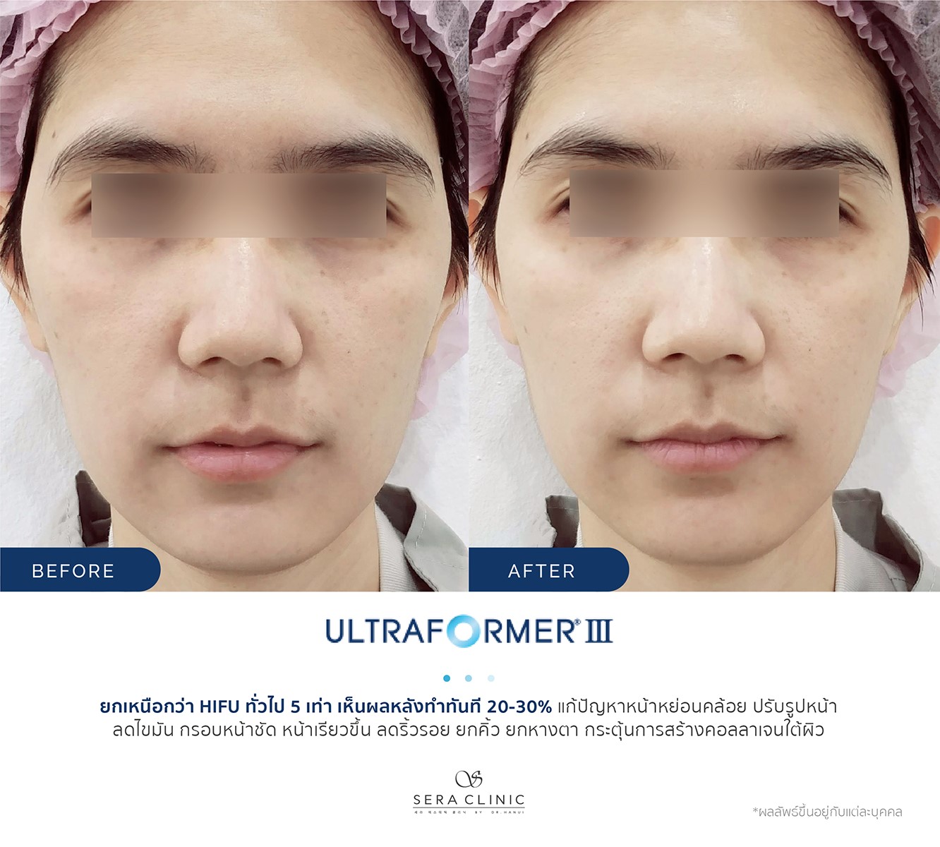 review รีวิว Ultraformer lll ยกกระชับ หน้าเรียว ลดเหนียง