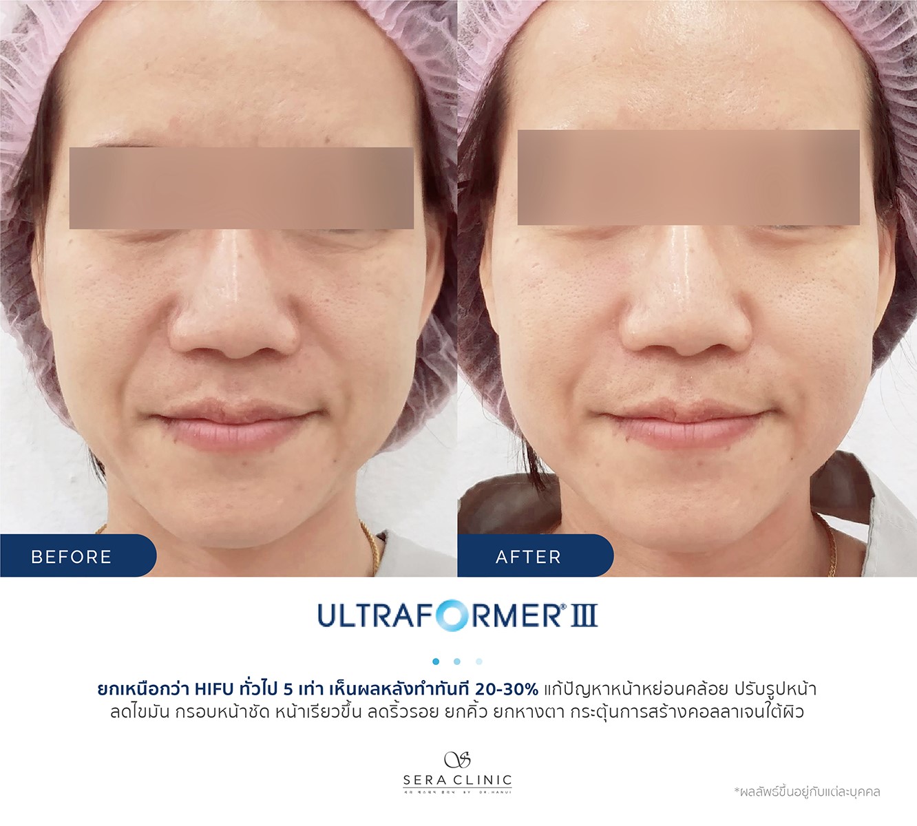 review รีวิว Ultraformer lll ยกกระชับ หน้าเรียว ลดเหนียง