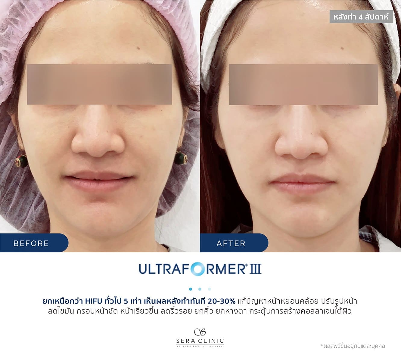review รีวิว Ultraformer lll ยกกระชับ หน้าเรียว ลดเหนียง