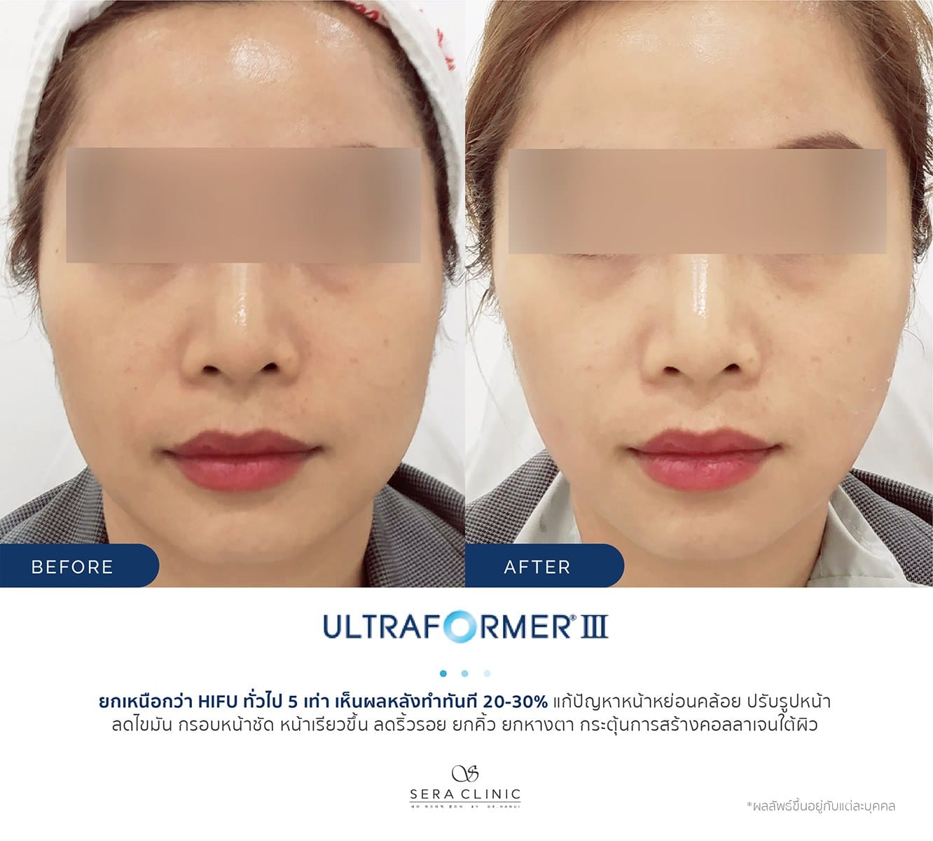 review รีวิว Ultraformer lll ยกกระชับ หน้าเรียว ลดเหนียง