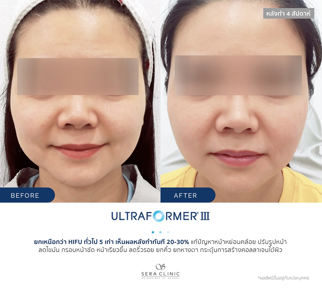 review รีวิว Ultraformer lll ยกกระชับ หน้าเรียว ลดเหนียง