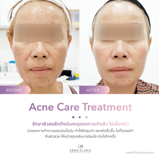 รีวิว review รักษาสิว acne care treatment