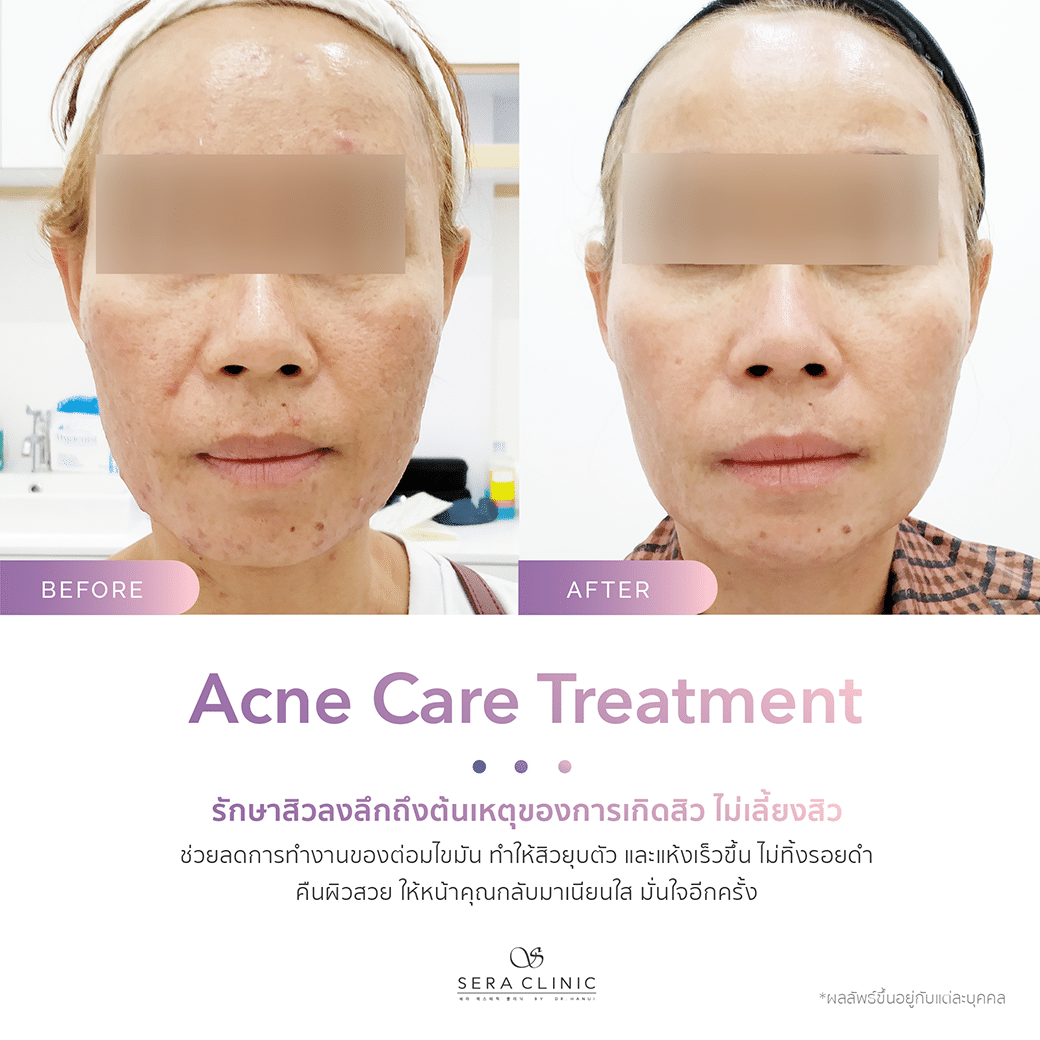 รีวิว review รักษาสิว acne care treatment รีวิว review รักษาสิว acne care treatment