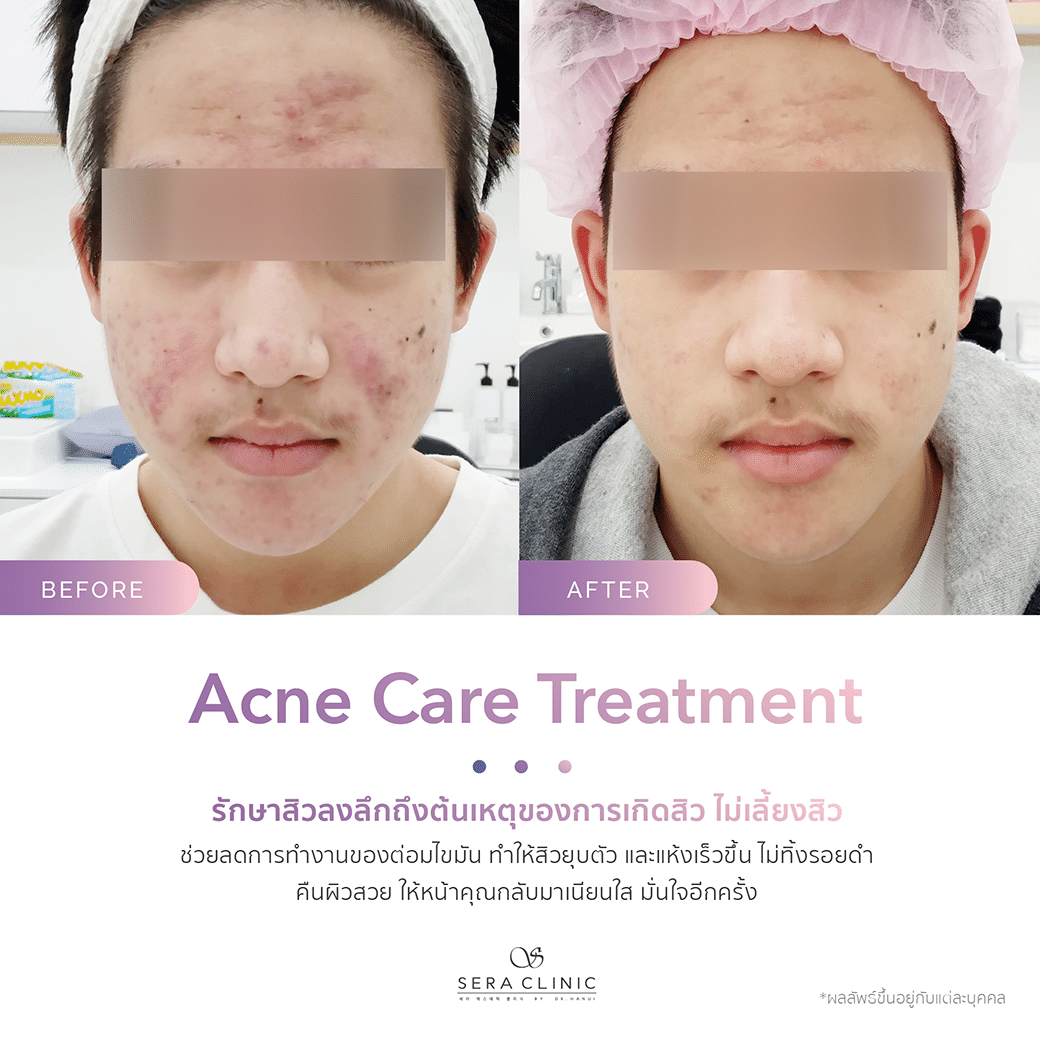 รีวิว review รักษาสิว acne care treatment