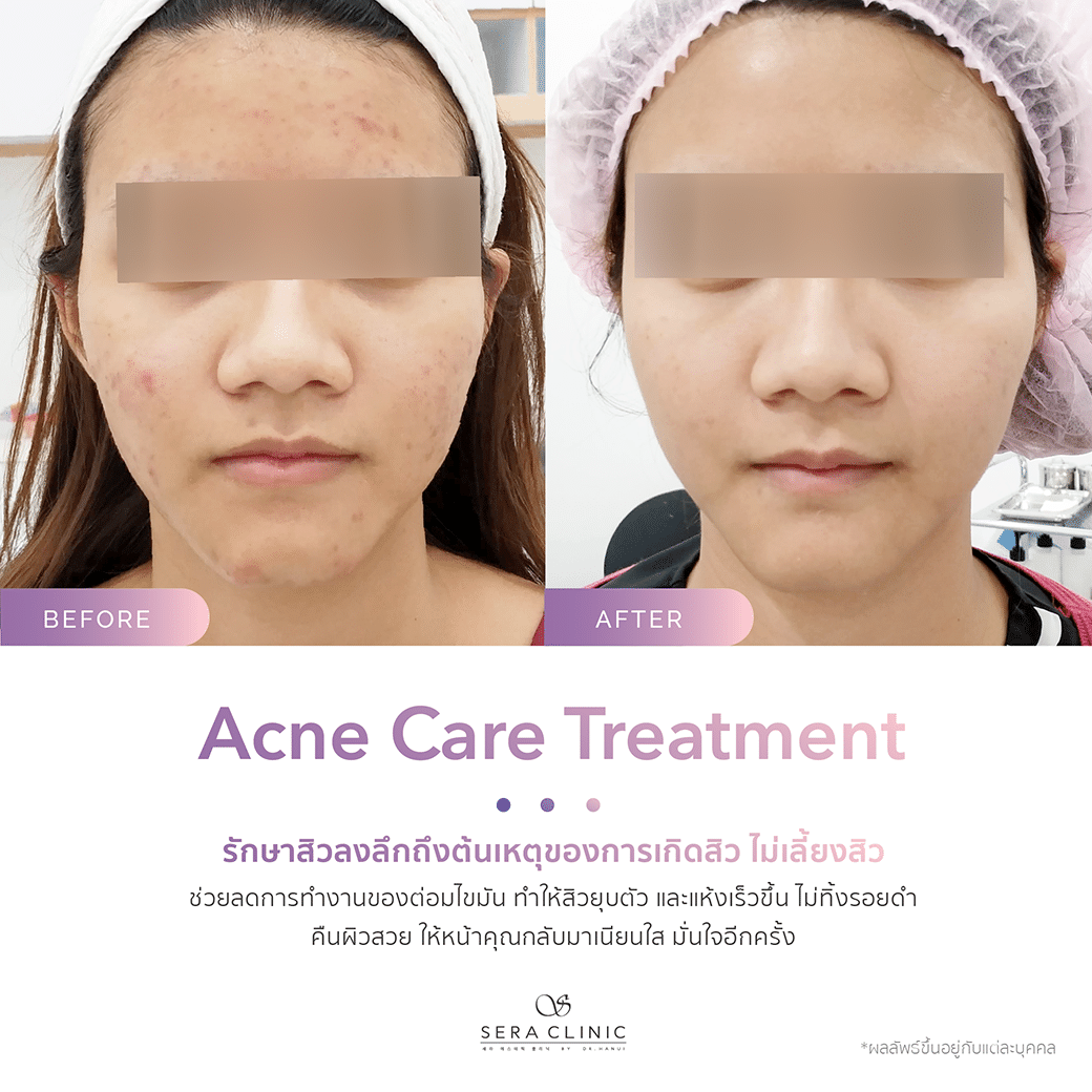 รีวิว review รักษาสิว acne care treatment