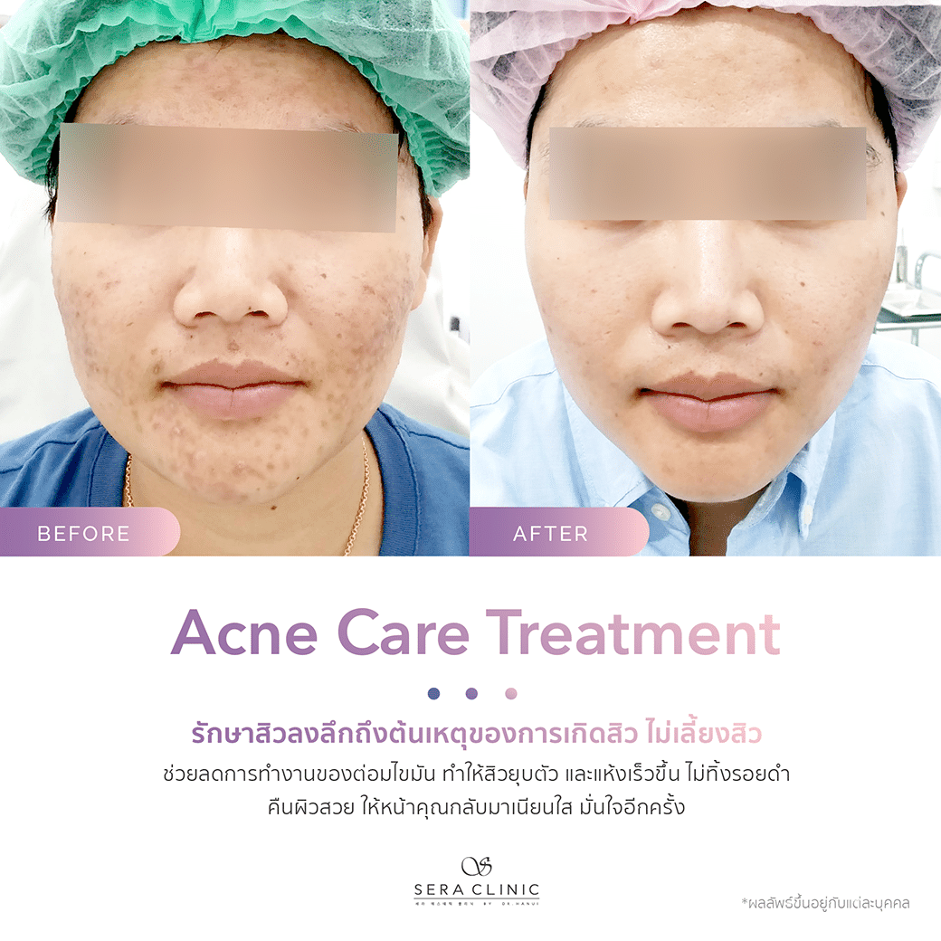 รีวิว review รักษาสิว acne care treatment