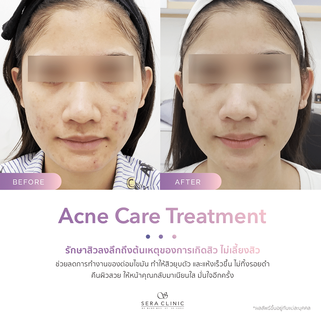 รีวิว review รักษาสิว acne care treatment