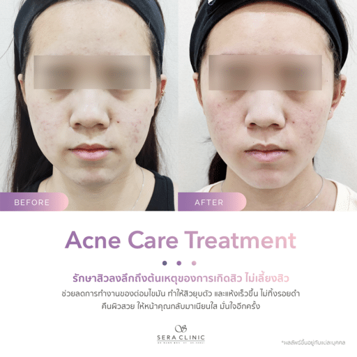 รีวิว review รักษาสิว acne care treatment