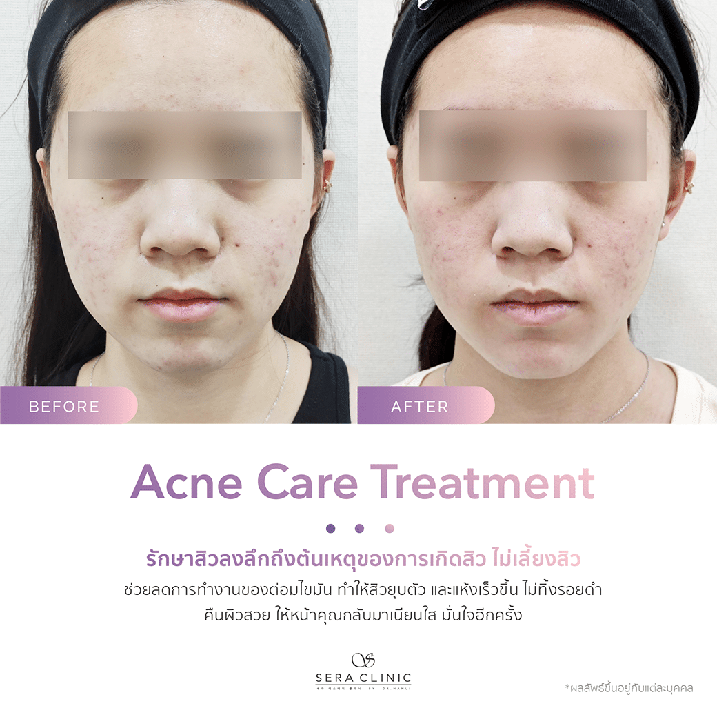 รีวิว review รักษาสิว acne care treatment