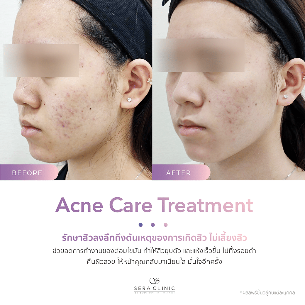 รีวิว review รักษาสิว acne care treatment รีวิว review รักษาสิว acne care treatment