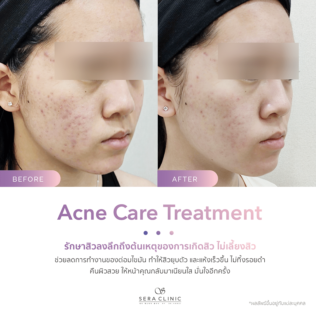 รีวิว review รักษาสิว acne care treatment รีวิว review รักษาสิว acne care treatment