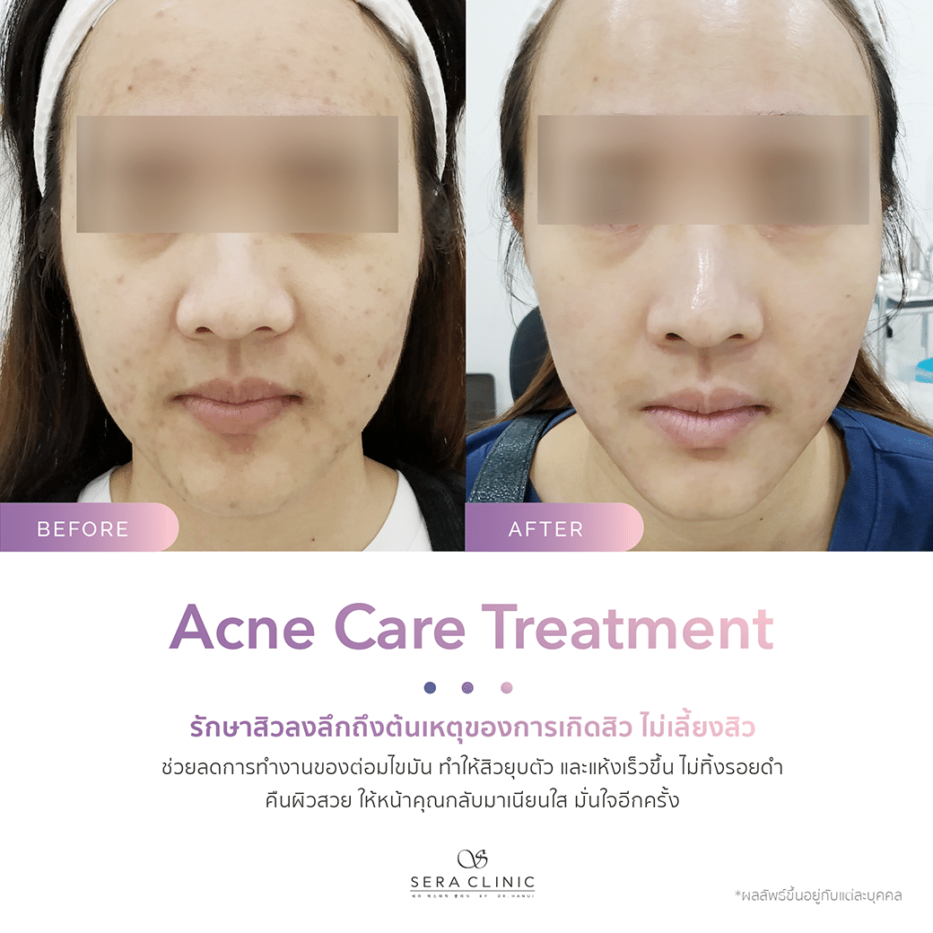 รีวิว review รักษาสิว acne care treatment